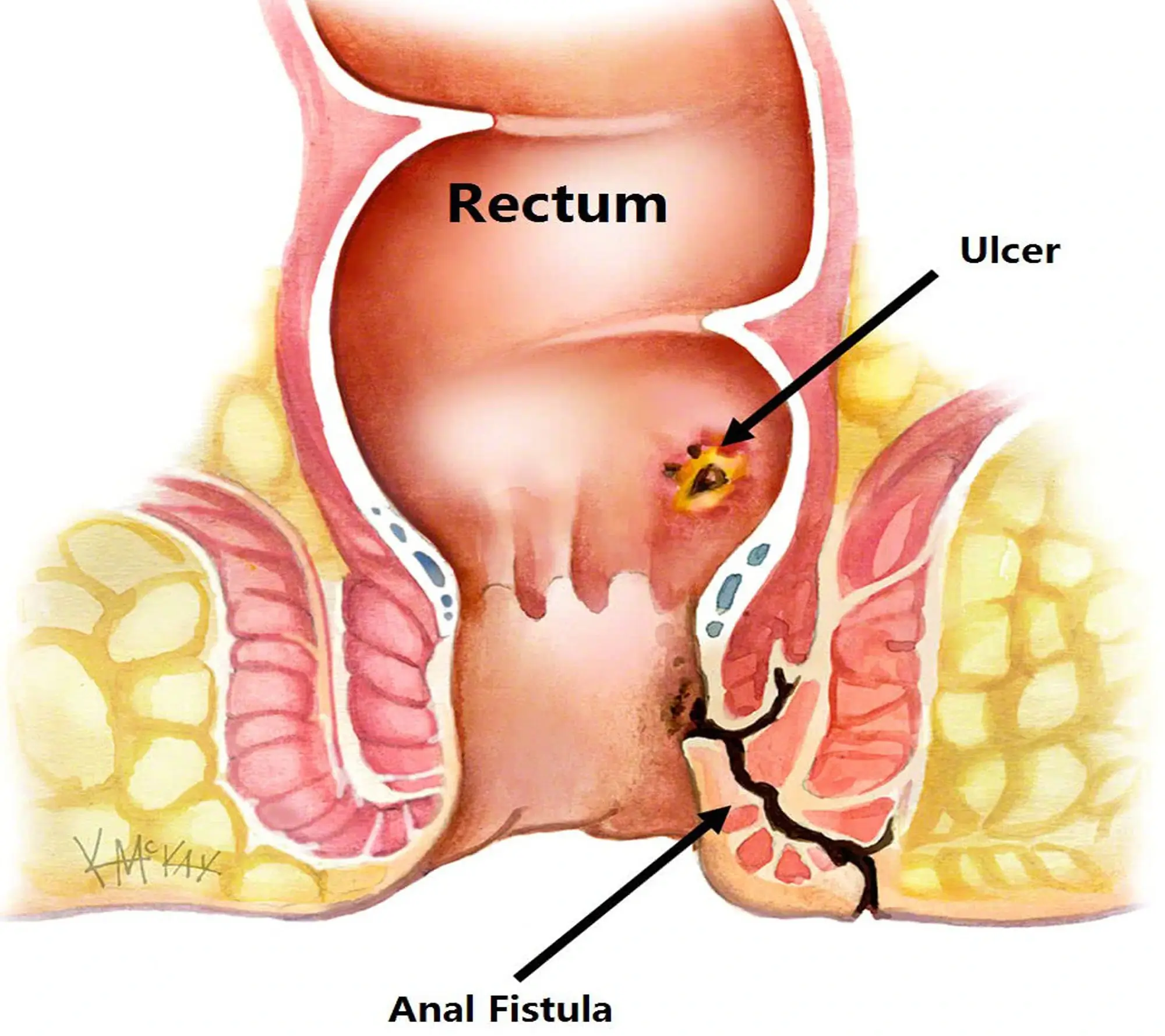 Best laparoscopic surgeon in Patna, laparoscopic gallbladder surgery, laser operation for gall bladder stone, piles doctor in Patna, laser surgery for piles, laser surgery for fissure, laser fistula surgery, laparoscopic appendix surgery, Hernia Surgery in Patna, Best Hernia Surgery in Patna, Laparoscopic Hernia, Surgery in Patna, laparoscopic gallbladder surgery in Patna, laser operation for gall bladder stone in Patna, laser surgery for piles in patna, laser surgery for fissure in patna, laser fistula surgery in patna, best laparoscopic surgeon in patna, best piles doctor in patna, hernia surgeon in patna, hernia specialist in patna, hernia center in patna, hernia operation in patna, gallbladder stone surgery in patna, gall bladder stone operation in patna, fistula doctor in patna, top laparoscopic surgeon in patna, Laser surgery for Prostate, Laser surgery for Kidney stone, Laser surgery for stone in ureter, Laser surgery for stone in urinary bladder, Best kidney stone surgeon in Patna , Best Prostate surgeon in Patna, Best Urologist in Patna, Best Urethral stricture surgeon in Patna, Best Urinary Bladder stone surgeon in Patna, general surgeon in patna, Piles surgeon in Patna, bawasir surgeon in patna, bawasir doctor in patna. bawasir specialist doctor in patna, bawasir specialist in patna, fistula laser treatment cost in patna, laparoscopic appendix surgery in Patna