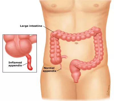 Best laparoscopic surgeon in Patna, laparoscopic gallbladder surgery, laser operation for gall bladder stone, piles doctor in Patna, laser surgery for piles, laser surgery for fissure, laser fistula surgery, laparoscopic appendix surgery, Hernia Surgery in Patna, Best Hernia Surgery in Patna, Laparoscopic Hernia, Surgery in Patna, laparoscopic gallbladder surgery in Patna, laser operation for gall bladder stone in Patna, best laparoscopic surgeon in patna, best piles doctor in patna, hernia surgeon in patna, hernia specialist in patna, hernia center in patna, hernia operation in patna, gallbladder stone surgery in patna, gall bladder stone operation in patna, fistula doctor in patna, top laparoscopic surgeon in patna, general surgeon in patna, fistula laser treatment cost in patna, laser surgery for piles in patna, laser surgery for fissure in patna, Laser surgery for Prostate, Laser surgery for Kidney stone, Laser surgery for stone in ureter, Laser surgery for stone in urinary bladder, Best kidney stone surgeon in Patna , Best Prostate surgeon in Patna, Best Urologist in Patna, Best Urethral stricture surgeon in Patna, Best Urinary Bladder stone surgeon in Patna, Piles surgeon in Patna, bawasir surgeon in patna, bawasir doctor in patna. bawasir specialist doctor in patna, bawasir specialist in patna, laser fistula surgery in patna, laparoscopic appendix surgery in Patna
