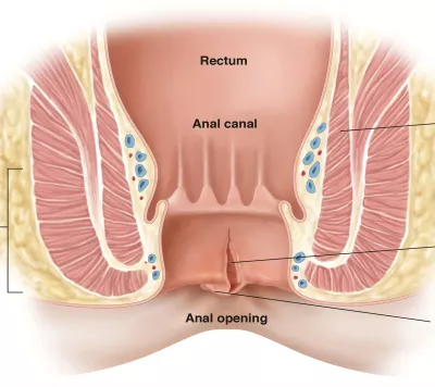 Best laparoscopic surgeon in Patna, laparoscopic gallbladder surgery, laser operation for gall bladder stone, piles doctor in Patna, laser surgery for piles, laser surgery for fissure, laser fistula surgery, laparoscopic appendix surgery, Hernia Surgery in Patna, Best Hernia Surgery in Patna, Laparoscopic Hernia, Surgery in Patna, laparoscopic gallbladder surgery in Patna, laser operation for gall bladder stone in Patna, laser surgery for piles in patna, laser surgery for fissure in patna, best laparoscopic surgeon in patna, best piles doctor in patna, hernia surgeon in patna, hernia specialist in patna, hernia center in patna, hernia operation in patna, gallbladder stone surgery in patna, gall bladder stone operation in patna, fistula doctor in patna, top laparoscopic surgeon in patna, general surgeon in patna, fistula laser treatment cost in patna, laser fistula surgery in patna, Laser surgery for Prostate, Laser surgery for Kidney stone, Laser surgery for stone in ureter, Laser surgery for stone in urinary bladder, Best kidney stone surgeon in Patna , Best Prostate surgeon in Patna, Best Urologist in Patna, Best Urethral stricture surgeon in Patna, Piles surgeon in Patna, bawasir surgeon in patna, bawasir doctor in patna. bawasir specialist doctor in patna, bawasir specialist in patna, Best Urinary Bladder stone surgeon in Patna, laparoscopic appendix surgery in Patna