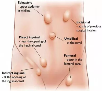 Best laparoscopic surgeon in Patna, laparoscopic gallbladder surgery, laser operation for gall bladder stone, piles doctor in Patna, laser surgery for piles, laser surgery for fissure, laser fistula surgery, laparoscopic appendix surgery, Hernia Surgery in Patna, Best Hernia Surgery in Patna, Laparoscopic Hernia, Surgery in Patna, laparoscopic gallbladder surgery in Patna, laser operation for gall bladder stone in Patna, laser surgery for piles in patna, best laparoscopic surgeon in patna, best piles doctor in patna, hernia surgeon in patna, hernia specialist in patna, hernia center in patna, hernia operation in patna, gallbladder stone surgery in patna, gall bladder stone operation in patna, fistula doctor in patna, top laparoscopic surgeon in patna, general surgeon in patna, fistula laser treatment cost in patna, laser surgery for fissure in patna, Laser surgery for Prostate, Laser surgery for Kidney stone, Laser surgery for stone in ureter, Laser surgery for stone in urinary bladder, Best kidney stone surgeon in Patna , Best Prostate surgeon in Patna, Best Urologist in Patna, Best Urethral stricture surgeon in Patna, Best Urinary Bladder stone surgeon in Patna, Piles surgeon in Patna, bawasir surgeon in patna, bawasir doctor in patna. bawasir specialist doctor in patna, bawasir specialist in patna, laser fistula surgery in patna, laparoscopic appendix surgery in Patna